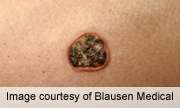 Common therapies for basal cell carcinoma offer similar survival