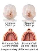 Considerable variation in outcomes for cleft lip/Palate