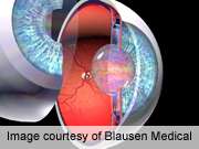 Contact lens sensor measures 24-hour intraocular pressure