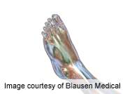 Correlates of diabetic foot complications identified