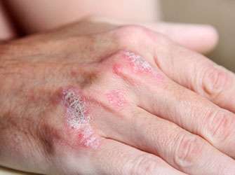 Dermatitis could be suppressed as it develops