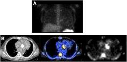 Difficult to diagnose cases of infectious endocarditis solved with SPECT/CT imaging agent