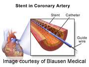 Dissolvable heart artery stents appear safe in study