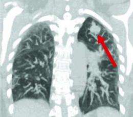 Early-stage lung cancer treatments evaluated in patients with breathing problems