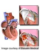 Early surgery ups outcomes in infective endocarditis