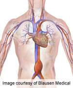 血管内、开放性动脉瘤修复术长期生存率类似