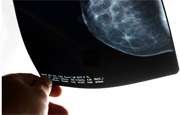 Face-down position may be safer during radiation for breast cancer: study