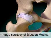 FDA probing safety of metal-on-metal hip implants