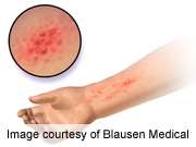 Filaggrin mutations up risk of irritant contact dermatitis