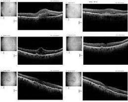 First oral agent to quell invasive macular degeneration, restore lost vision