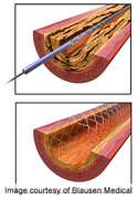 Good long-Term outcomes for drug-Eluting stents