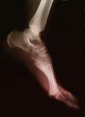High BMI tied to non-Specific foot pain, plantar heel pain