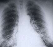 高VEGF信号分数与肺癌的预后