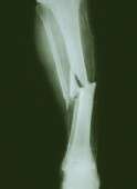Hip fracture surgery type impacts future fracture risk