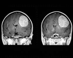 Improved image analysis for MRI