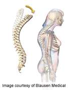 Kyphoplasty superior to vertebroplasty for vertebral fx