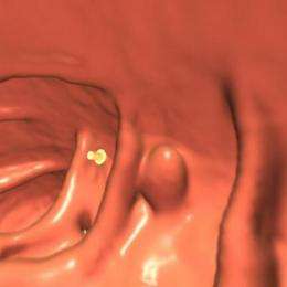 Laxative-free CT colonography may be as accurate as colonoscopy in detecting high-risk polyps