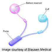 Leaving balloon in is safe in urinary sphincter revision