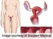 在子宫内膜癌复发的巴氏试验值有限