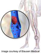 Long-term mortality risk low after cerebral vein thrombosis