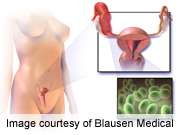 &lt;i&gt;M. genitalium&lt;/i&gt; ups risk of pelvic inflammatory disease, cervicitis