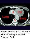 Lung cancer screening might pay off, analysis shows
