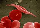 Mapping the global burden of sickle cell anaemia