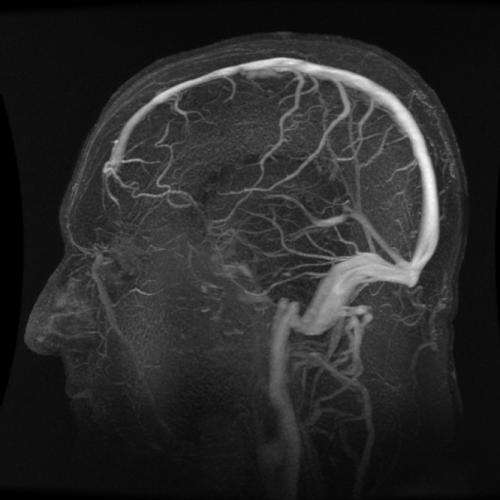 Measuring skull pressure without the headache