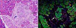 Metastasis of pancreatic cancer in action
