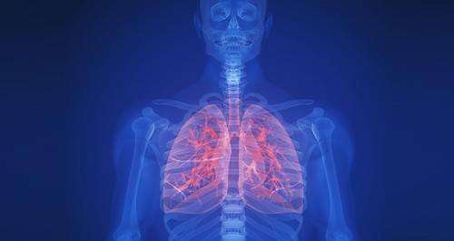 Molecular lung cancer test identifies patients at high risk of death even after surgery