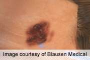 Negative pigment network able to distinguish melanoma