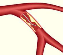 New study clarifies benefits of coronary stents