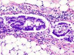 NIH researchers identify novel genes that may drive rare, aggressive form of uterine cancer