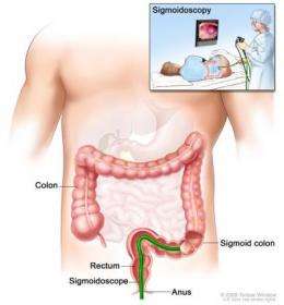 NIH study finds sigmoidoscopy reduces colorectal cancer rates