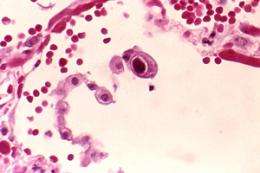 NIST standard available for better diagnosis, treatment of cytomegalovirus