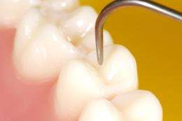 No evidence to support removing impacted wisdom teeth