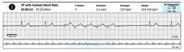 Novel electrotherapy greatly reduces the energy needed to shock a heart back into rhythm