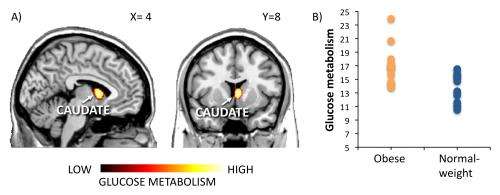 Obesity is associated with altered brain function