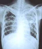 One in four tuberculosis cases due to recent transmission