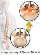 Pain, disability don't predict function in spinal stenosis
