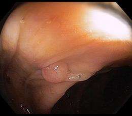 Poor colonoscopy prep hides pre-cancerous polyps