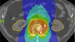 Project to improve radiotherapy planning
