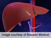 QoL up for live liver donors versus general population