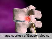 Radiography unnecessary after spinal fusion surgery