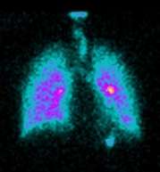 Research uses 3D imaging to improve the lives of lung disease patients