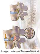 Review compares surgeries for sciatica due to herniated disc