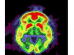 Same genes linked to early- and late-onset Alzheimer's