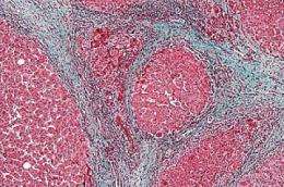 Scarring cells revert to inactive state as liver heals