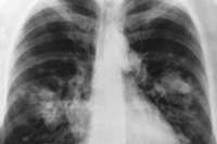 Skin rash predicts survival benefit from latest lung cancer drug