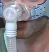 Sleep apnea 'Mask' might also help the heart